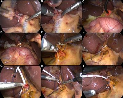 Primary closure combined with C-tube drainage through cystic duct after laparoscopic common bile duct exploration is safe and feasible for patients